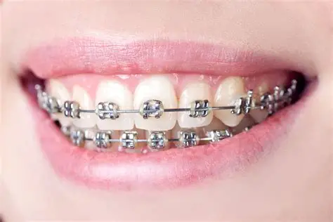 Braces