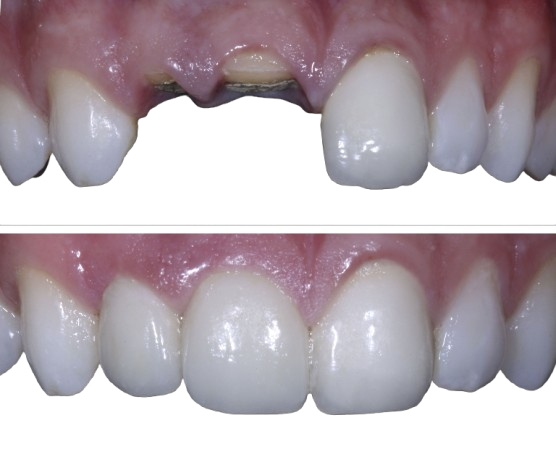 Root Canal Treatment Before & After